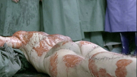Malcolm McDowell Naked as Mick Travis. Butt, blood, hospital. 135021