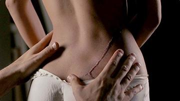 Women with Scars Fetish Burn Mark Burn Marks 1197
