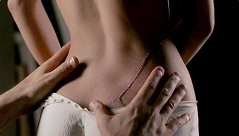 Women with Scars Fetish Burn Mark Burn Marks 1197